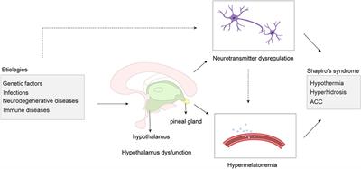 A new perspective of hypothalamic disease: Shapiro's syndrome